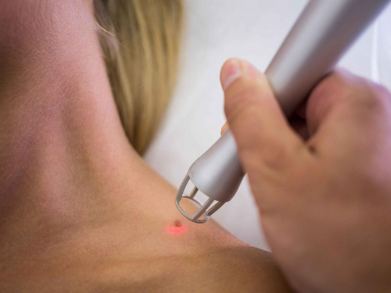 Đốt laser mụn cóc ở đâu - 4
