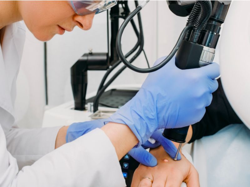Đốt mụn cóc bằng laser - 4