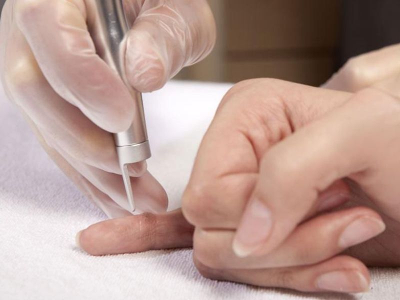 Đốt mụn cóc bằng laser - 6