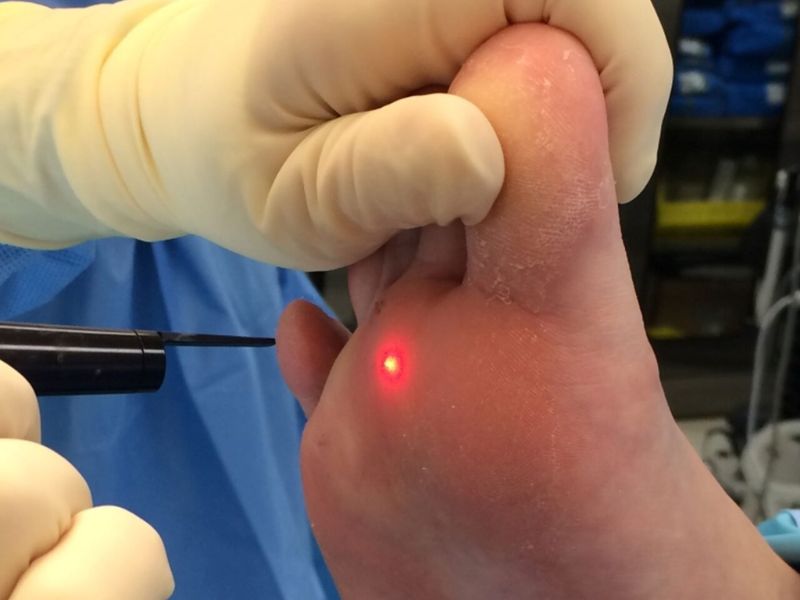 Đốt mụn cóc bằng laser bao nhiêu tiền - 1