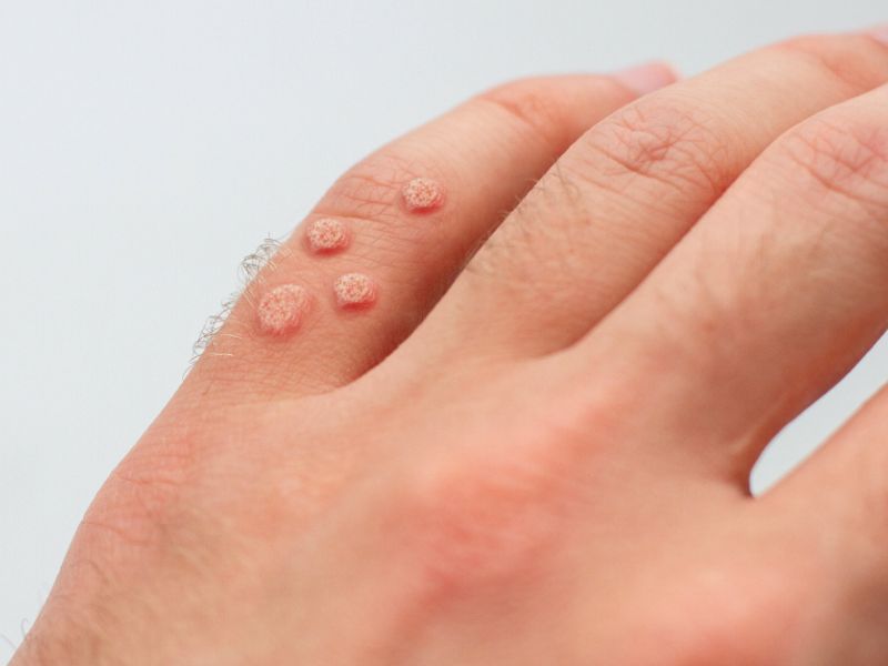 Đốt mụn cóc bằng laser bao nhiêu tiền - 4