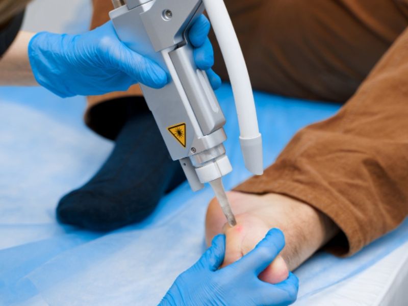 Đốt mụn cóc bằng laser bao nhiêu tiền - 6