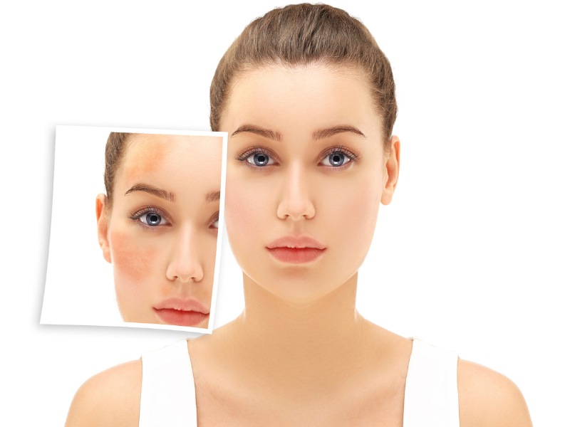 Review trị nám bằng laser -4