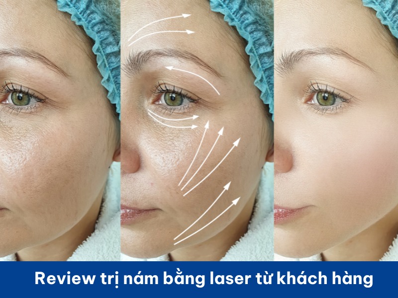 Review trị nám bằng laser -6