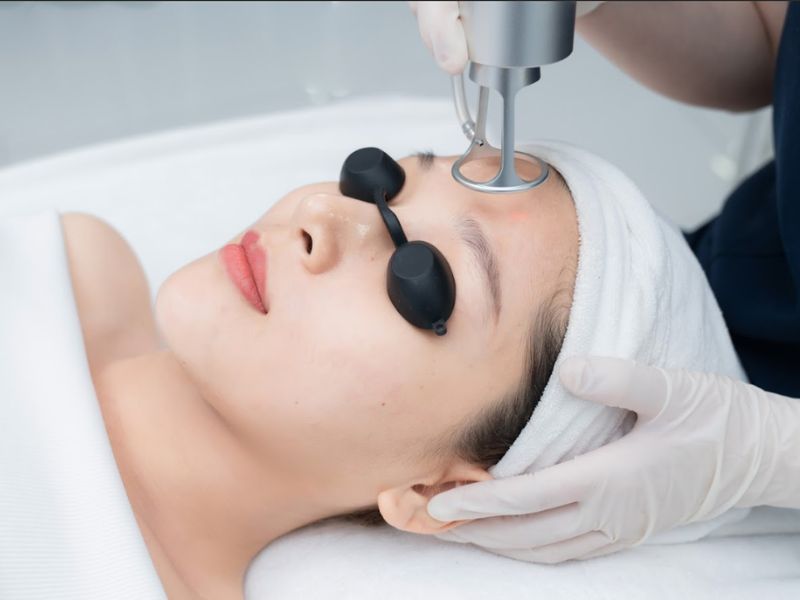 Trị mụn ẩn bằng laser - 1 Trị mụn ẩn bằng laser - 1