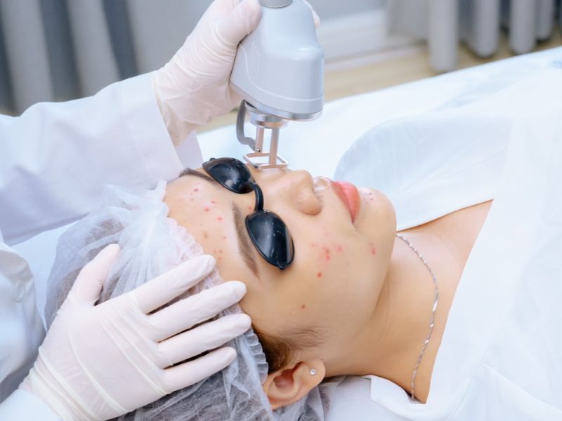 Trị mụn ẩn bằng laser - 11