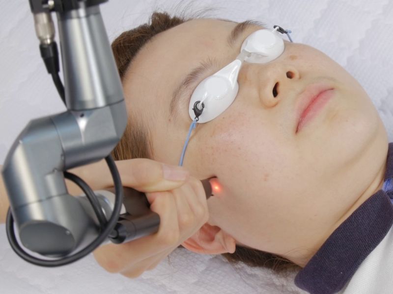 Trị mụn ẩn bằng laser - 3