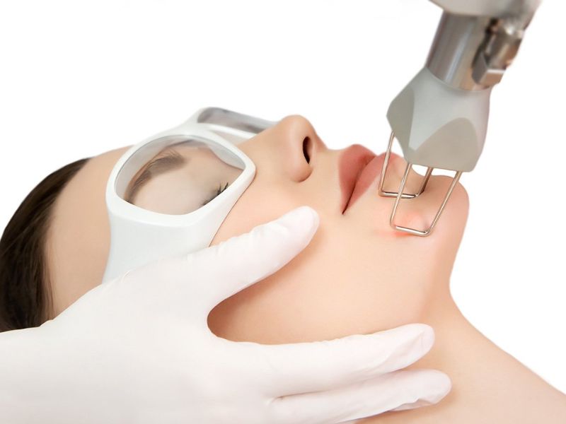 Trị mụn ẩn bằng laser - 4