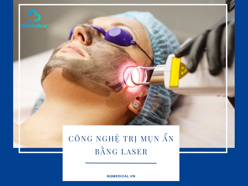 Trị mụn ẩn bằng laser