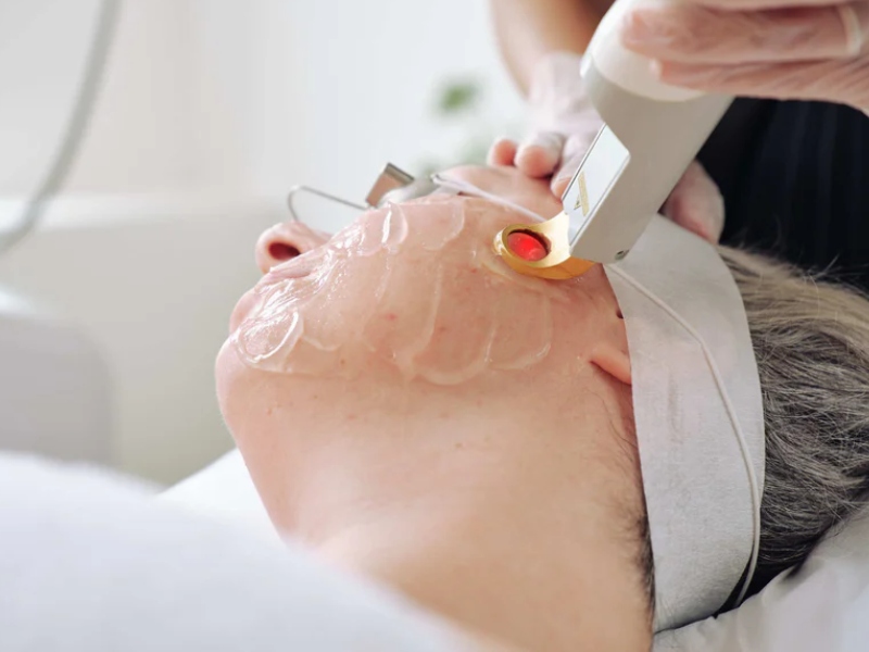 Trị mụn bằng laser - 1