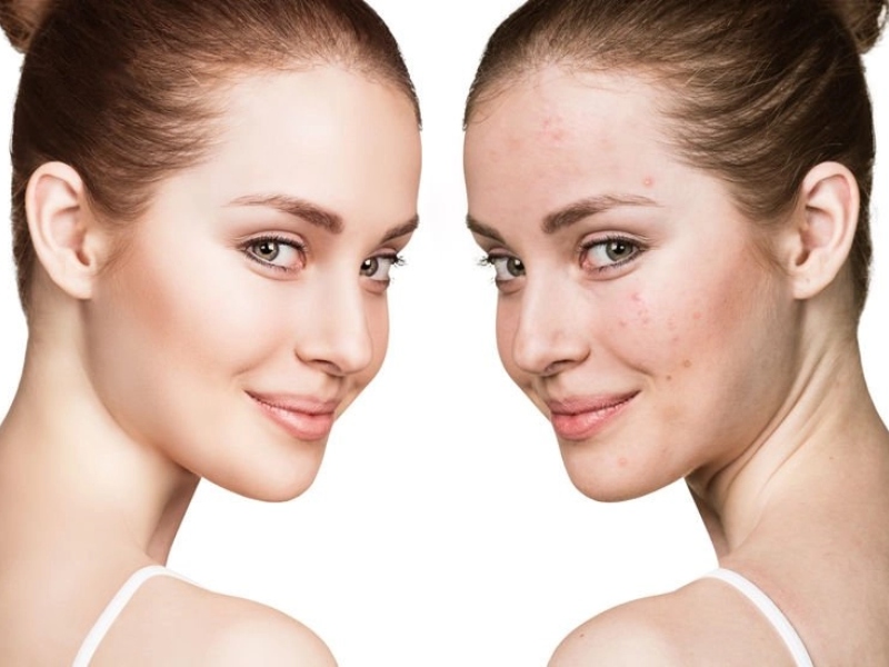 Trị mụn bằng laser - 10
