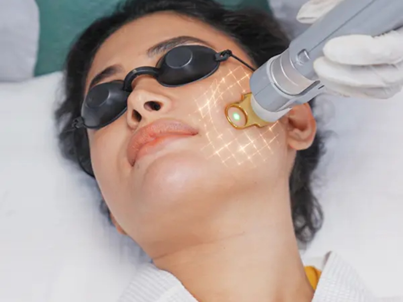 Trị mụn bằng laser - 2