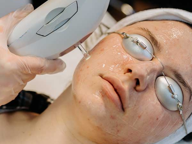 Trị mụn bằng laser - 3