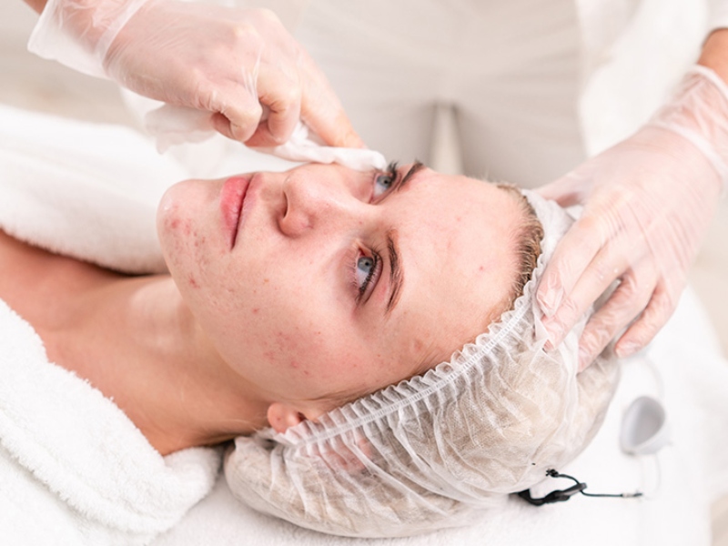 Trị mụn bằng laser - 5