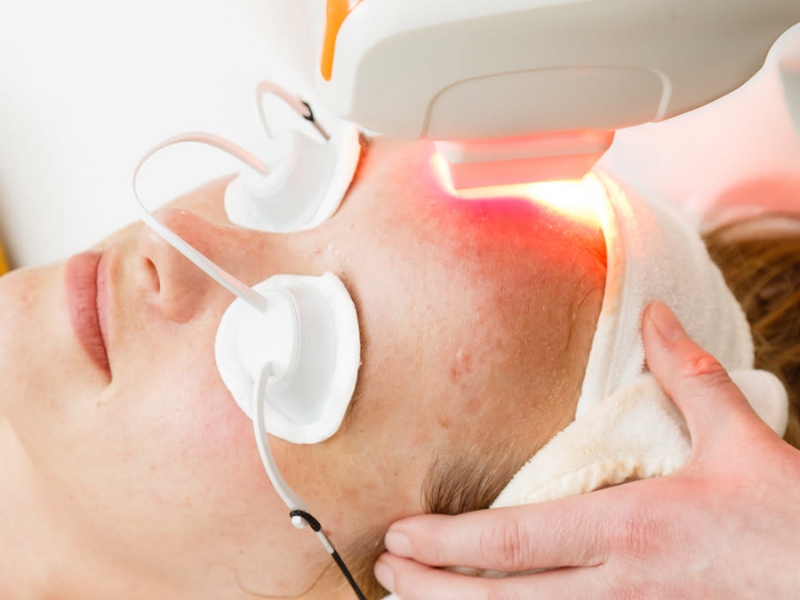 Trị mụn bằng laser - 6