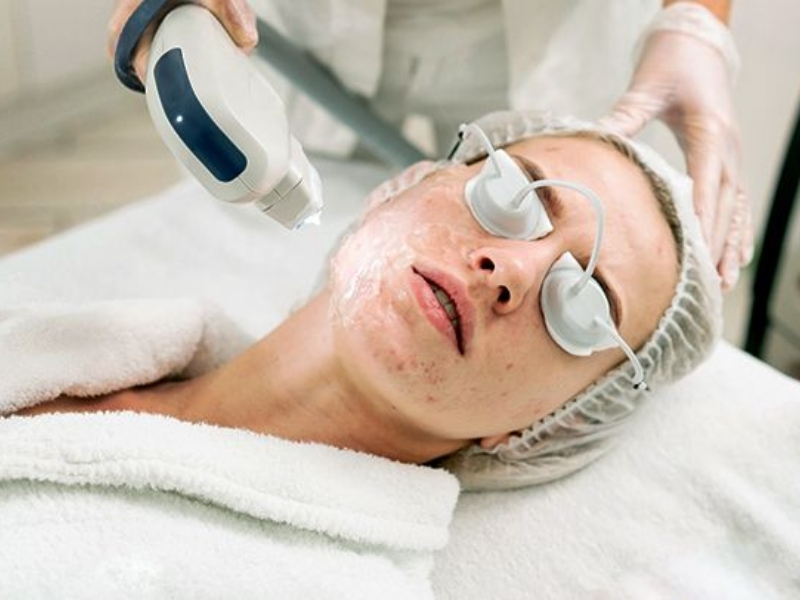 Trị mụn bằng laser có tốt không - 4