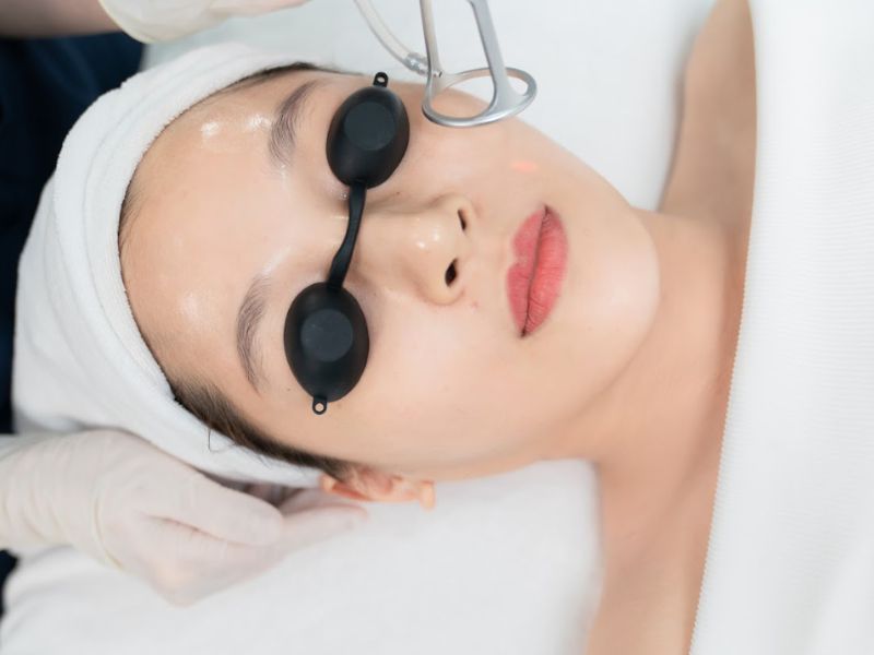 Trị mụn bằng laser giá bao nhiêu - 3