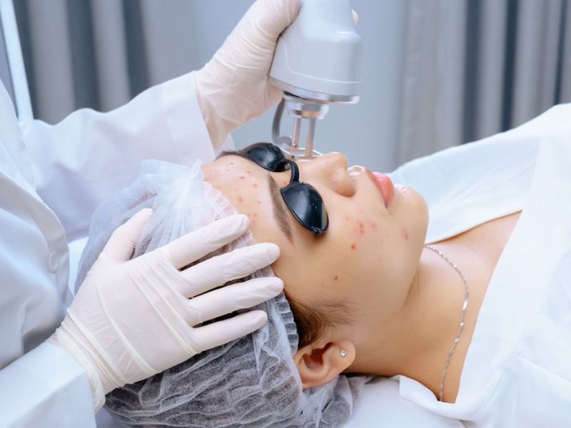 Trị mụn bằng laser giá bao nhiêu - 4