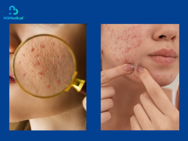 Trị mụn bằng laser giá bao nhiêu - 7