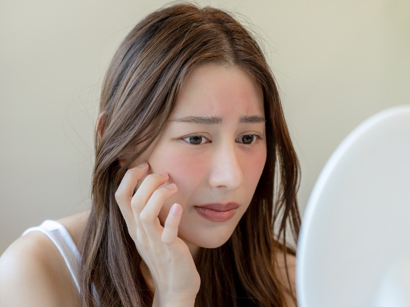 Trị sẹo bằng laser - 10