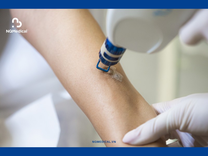 Trị sẹo bằng laser - 2