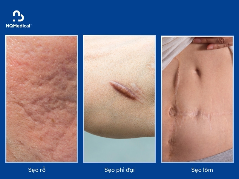 Trị sẹo bằng laser - 3