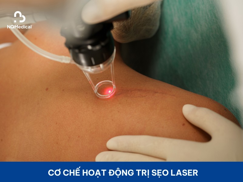 Trị sẹo bằng laser - 4