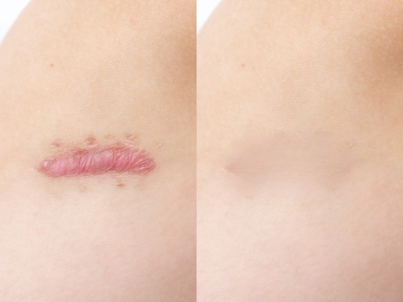 trị sẹo lồi bằng laser - 10