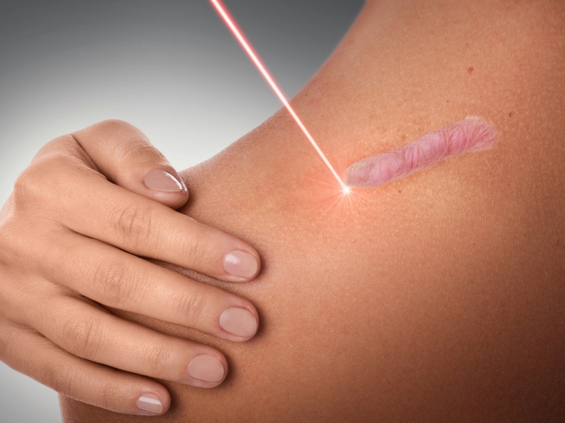 trị sẹo lồi bằng laser - 5