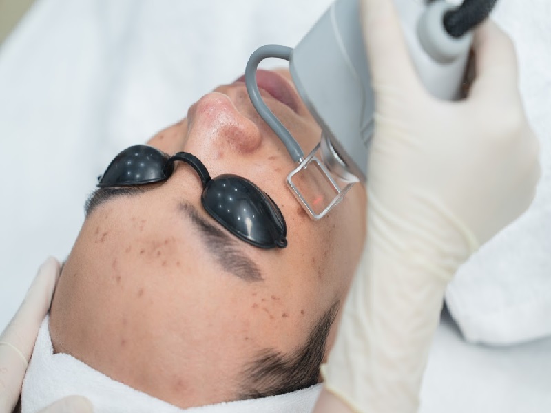 trị sẹo mụn bằng laser - 12