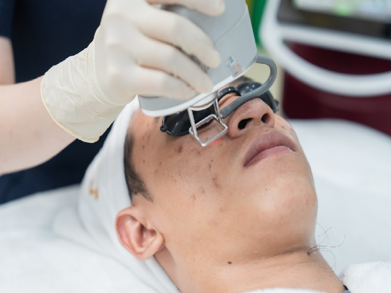 trị sẹo mụn bằng laser - 13