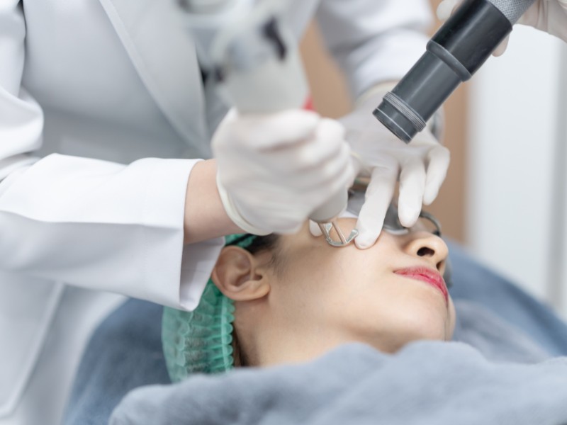 trị sẹo mụn bằng laser - 3