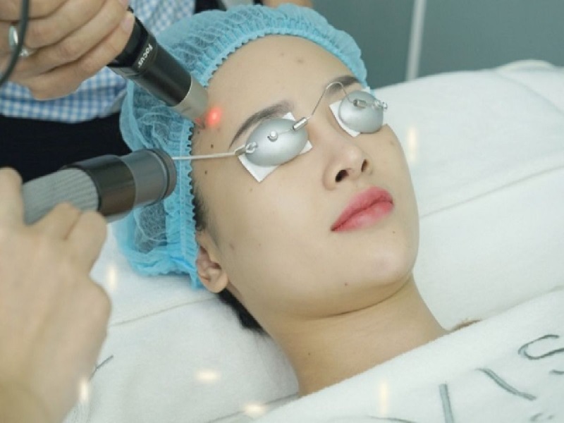 trị sẹo mụn bằng laser - 8