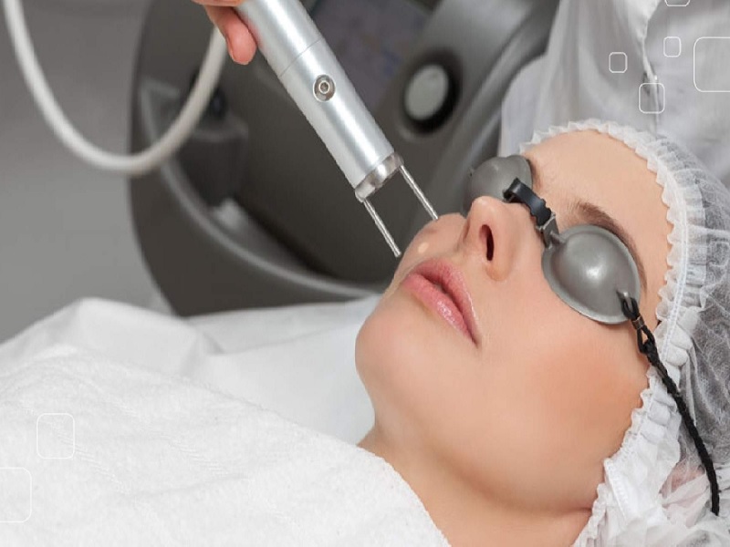 trị sẹo mụn bằng laser - 9