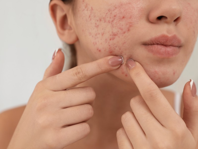 trị sẹo rỗ bằng laser - 2