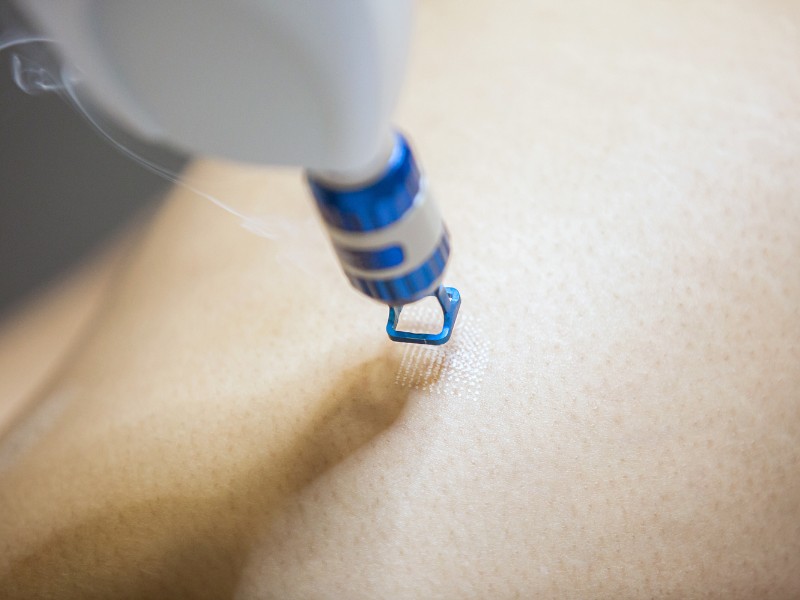 trị sẹo rỗ bằng laser - 9