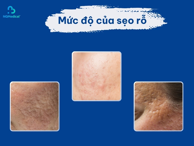 Trị sẹo rỗ bằng laser bao nhiêu tiền - 2