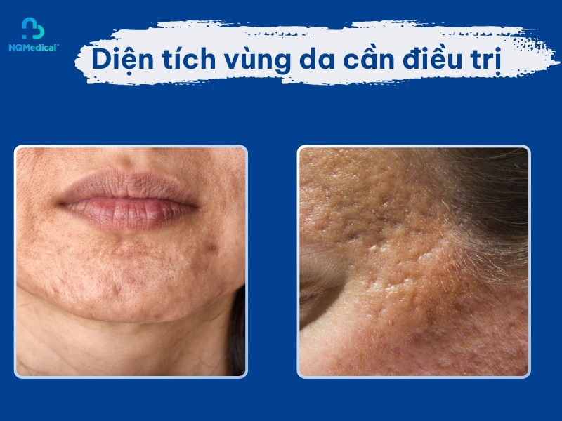 Trị sẹo rỗ bằng laser bao nhiêu tiền - 3