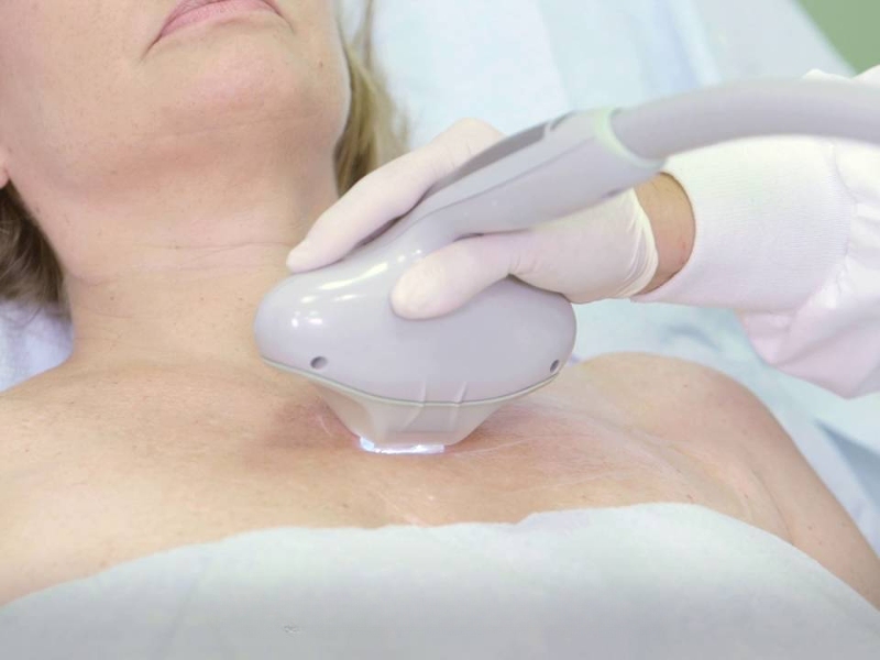 Trị tàn nhang bằng laser có hết không - 3
