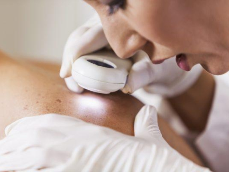 Trị tàn nhang bằng laser có hết không - 8