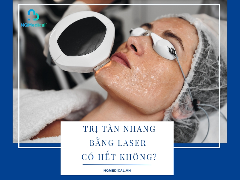 Trị tàn nhang bằng laser có hết không