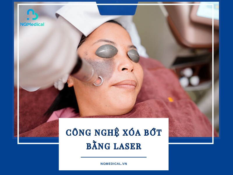 xóa bớt bằng laser