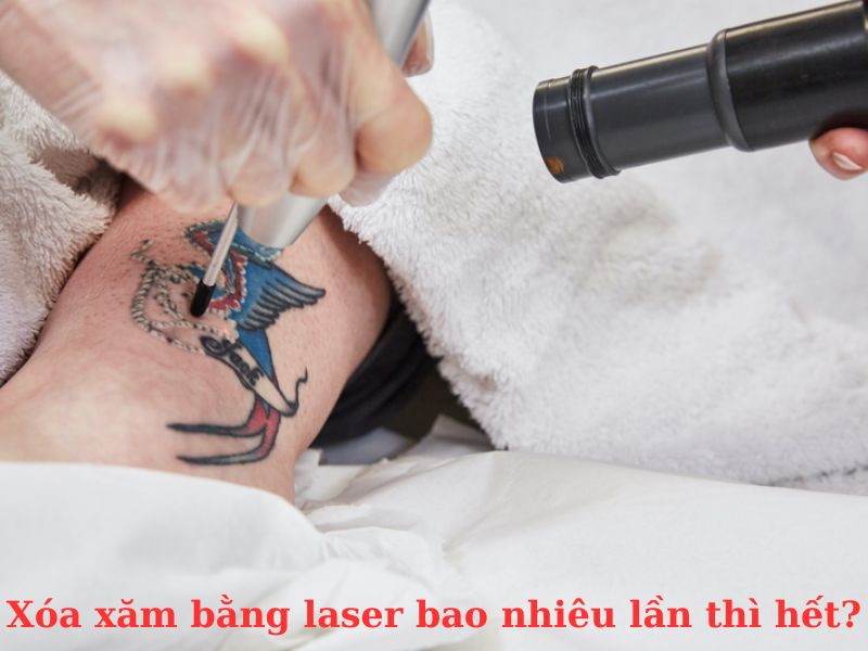 xóa xăm bằng laser bao nhiêu lần thì hết - 1