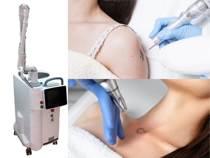 Xóa hình xăm bằng laser có đau không - 1