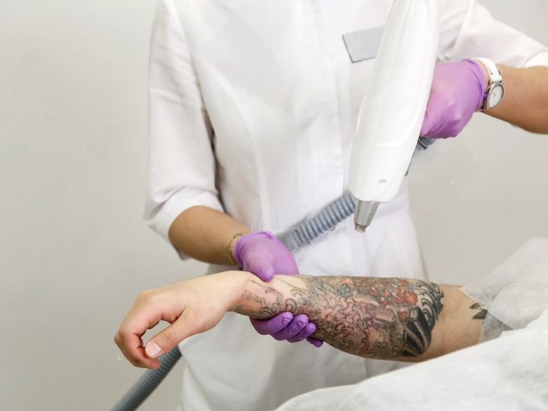 Xóa hình xăm bằng laser có đau không - 3