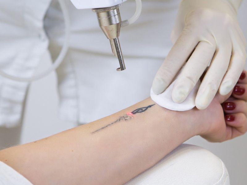 Xóa hình xăm bằng laser có đau không - 6