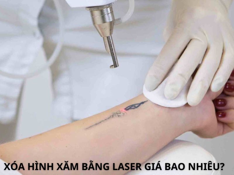Xóa hình xăm bằng Laser - 1