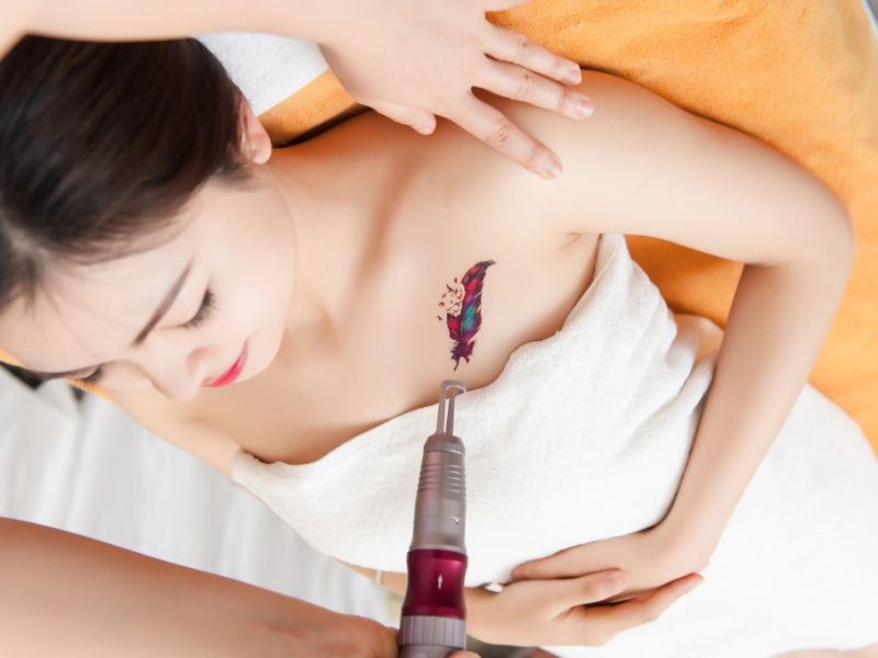 Xóa hình xăm bằng Laser - 2 Xóa hình xăm bằng Laser - 2