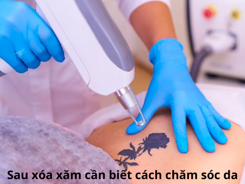 Xóa hình xăm bằng laser giá bao nhiêu - 5