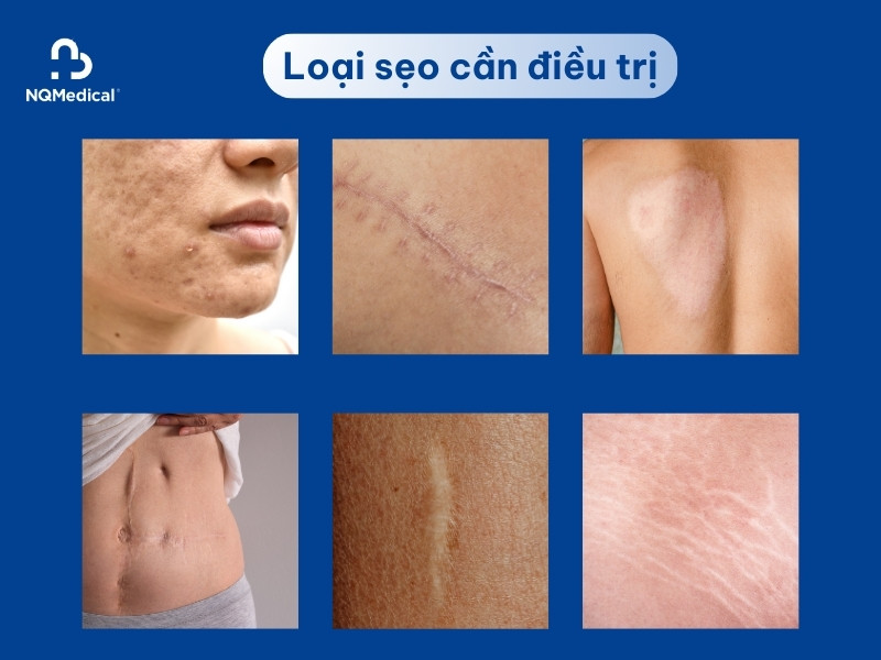 xóa sẹo bằng laser bao nhiêu tiền - 2